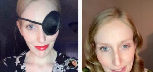 Mata Kanan Wanita Ini Tidak Bisa Dibuka Selama Sebulan, Akibat Gagal Suntik Botox