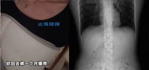 Seorang Wanita Asal Shanghai, Patah Tulang Rusuk Setelah Makan Pedas. Wanita yang bermarga Huang ini mengaku mengalami patah tulang rusuk.